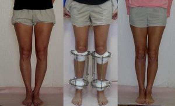 Варусное искривление коленных суставов